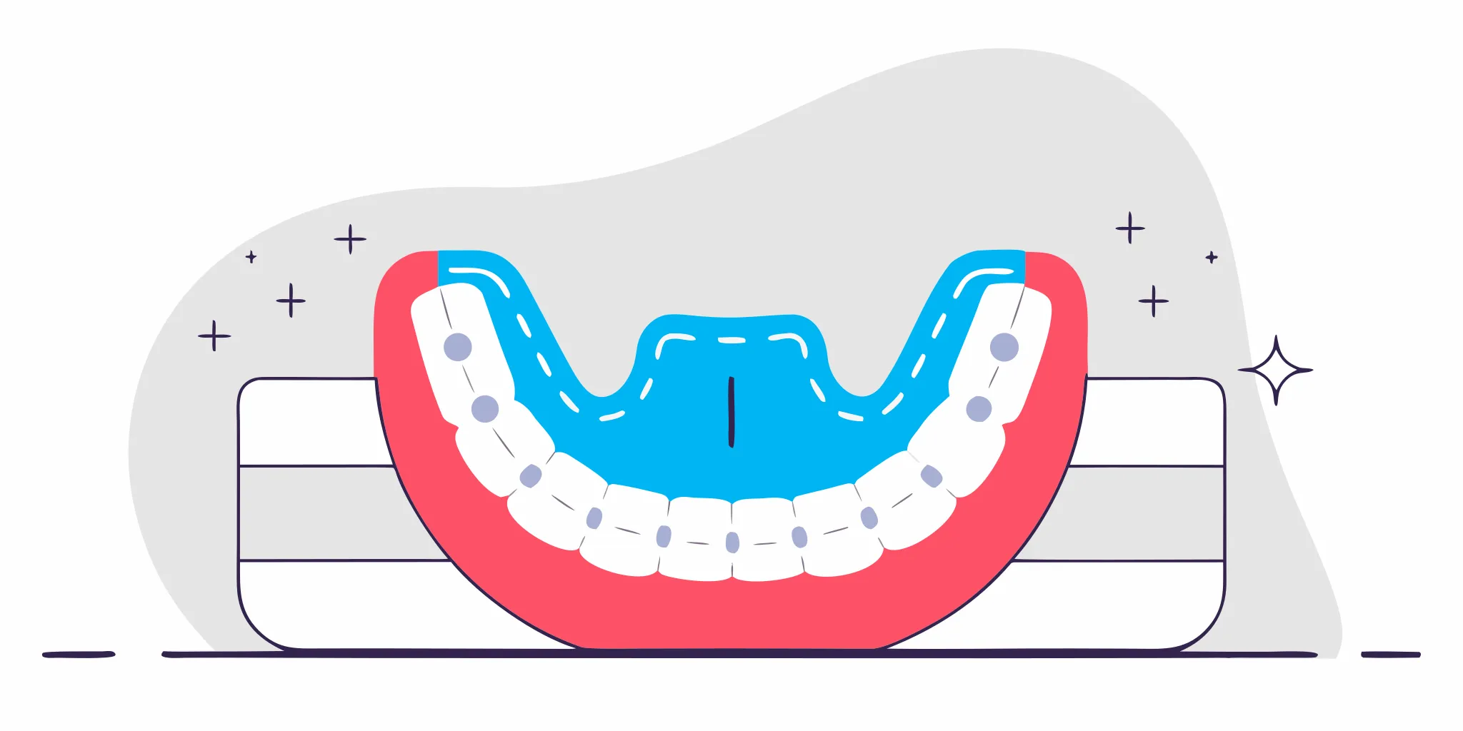 Custom-fitted mandibular advancement oral appliance dental device for treating sleep apnea