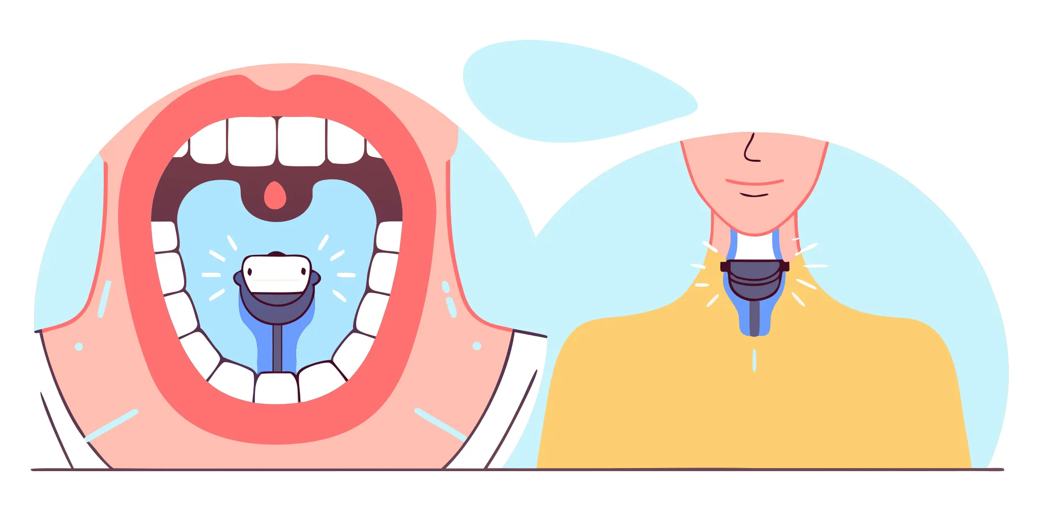 Clinical comparison diagram showing Inspire hypoglossal nerve stimulator implant versus custom oral appliance for sleep apnea treatment