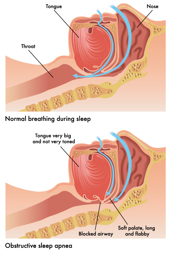 SleepDisorder How sleep apnea occurs